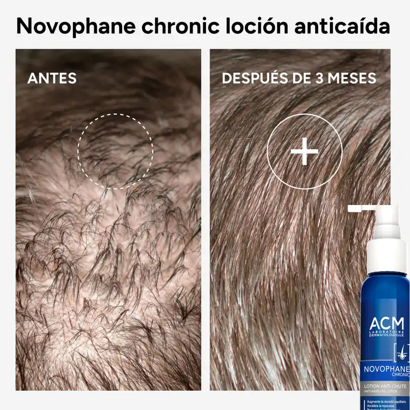 Acm Laboratoires Novophane Chronische Anti-Haarausfall-Lotion, 100 ml