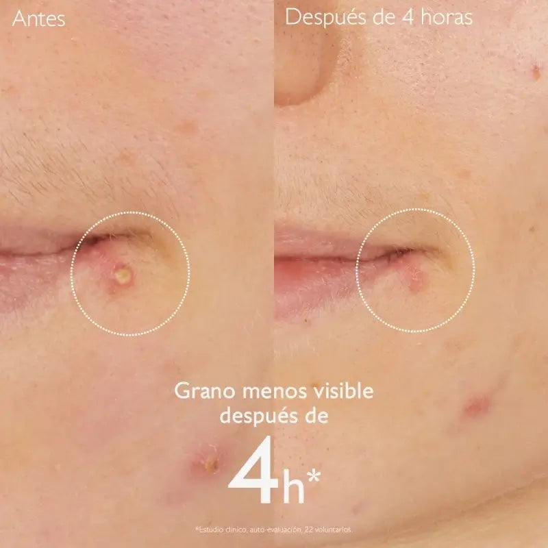 Caudalie Vinopure Stop Pickel Behandlung mit Salicylsäure, 15ml