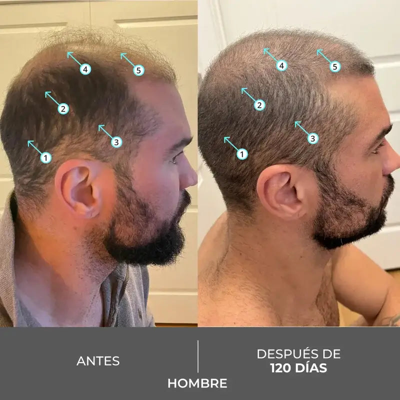 Ds Laboratories Revita Haar Dichte Stimulierende Haarausfall Stimulierende Shampoo, 205 ml