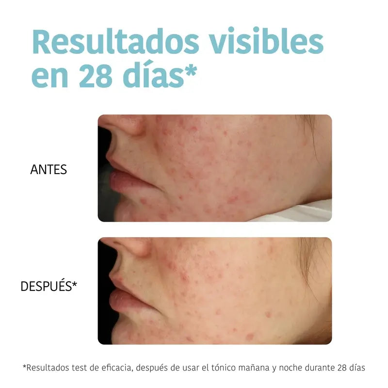 Iroha Nature Peeling für fettige Haut Anti-Perfektion Toning Discs, 50 Stück